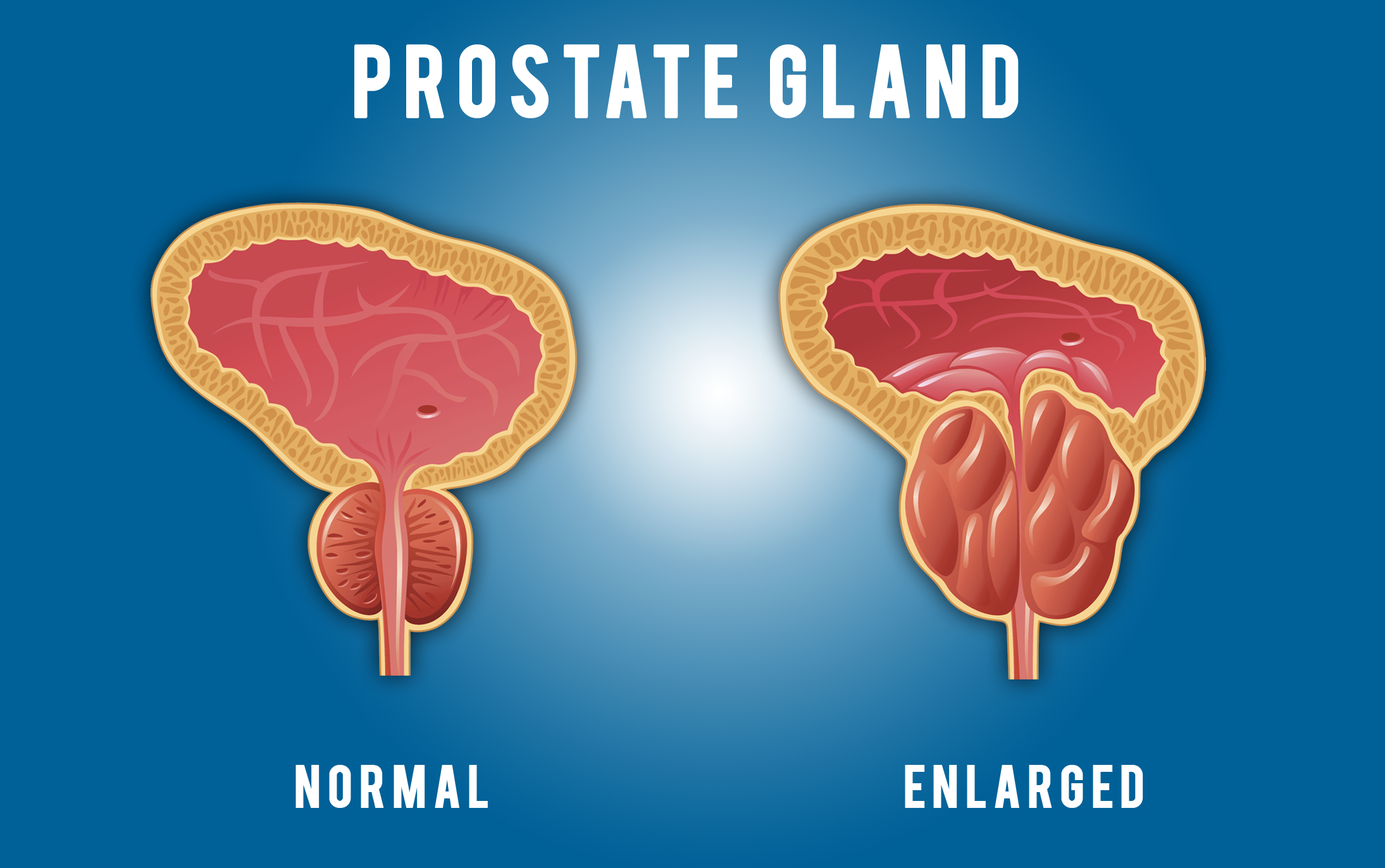 The Prostate Gland | Urologists in Ocala, FL