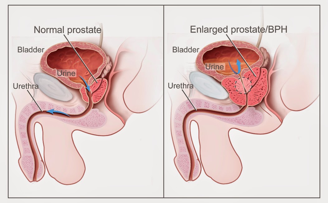 Prostate Enlargement