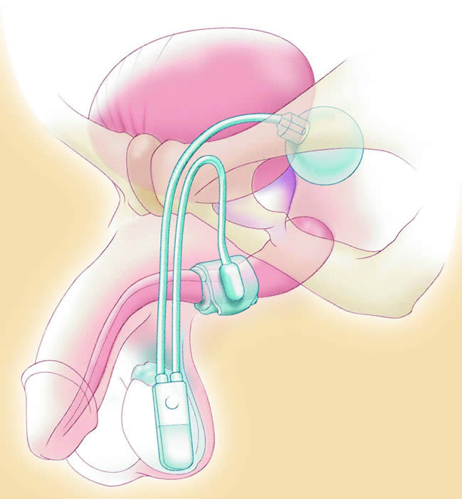 Artificial Sphincter for Male Incontinence