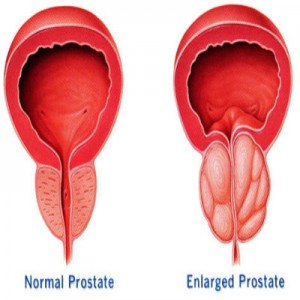 Symptoms and Types of Prostate Enlargement