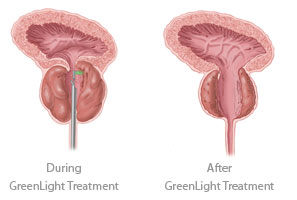 Green Light Laser Surgery for Prostate
