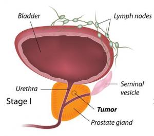 How Prostate Cancer Develops