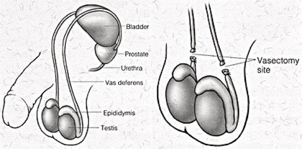 How a Vasectomy Prevents Pregnancy