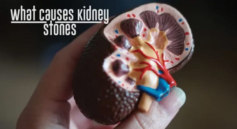 What Causes Kidney Stones